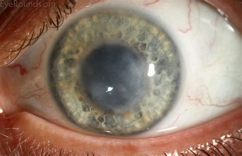 hermes zoster e ulcera alla cornea|varicella zoster corneal involvement.